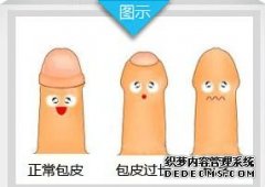 包皮过长是会让你的性功能出现障碍问题的，比如很多的早泄患者就是因为包皮过长导致的，很多的人不知道的是包皮过长还会让你的新阳光疾病出现的，很多的前列腺炎患者就是因为这