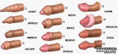 随着社会的不断发展，男性疾病的发病率增高，男性存在包皮过长的问题日益明显。越来越多的男性朋友受到包皮过长的困扰，给他们的健康造成了威胁，同时给他们的工作及生活带来