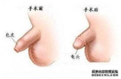 如今随着男性 包皮过长 的不断出现，男性朋友也逐渐的关注起自身的健康来了，很多男性朋友发现存在包皮过长的情况，都纷纷的到男科医院进行手术割除。包皮手术对于男性包皮过