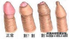 包皮过长 的情况在当下的生活中是很常见的，但是多数男性朋友并没有发觉，而且还没有好的卫生习惯，导致多种男性疾病出现，男性健康面临着重大的危机。一步一步的影响着家庭之