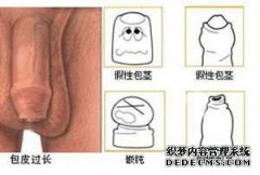 包皮过长 已经成为男性朋友普遍存在的一种生理现象，它是男性包皮的一种异常发展。很多男性朋友因为包皮过长的存在，未能及早的发现及治疗，从而诱发了男性早泄疾病。包皮过长